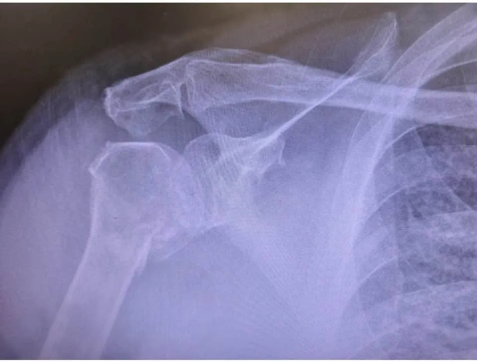 X-ray of Andre Risha’s shoulder showing the fractures